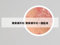 银屑病不红 银屑病不红一圈起皮