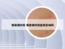 银屑病对肾 银屑病对肾脏有影响吗