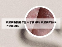 银屑病会随着年纪大了变种吗 银屑病年龄大了会减轻吗