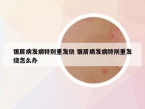 银屑病发病特别重发烧 银屑病发病特别重发烧怎么办