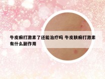 牛皮癣打激素了还能治疗吗 牛皮肤癣打激素有什么副作用