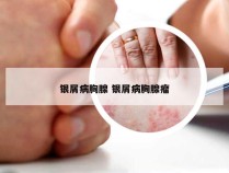 银屑病胸腺 银屑病胸腺瘤