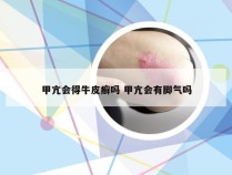 甲亢会得牛皮癣吗 甲亢会有脚气吗