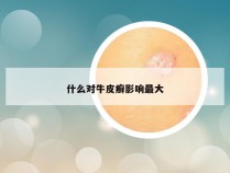 什么对牛皮癣影响最大