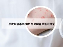 牛皮癣治不去根呢 牛皮癣再也治不好了
