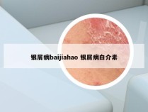 银屑病baijiahao 银屑病白介素