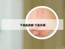 下体起皮癣 下身长癣