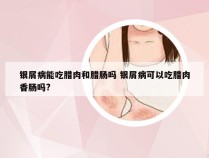 银屑病能吃腊肉和腊肠吗 银屑病可以吃腊肉香肠吗?