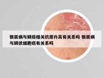 银屑病与鳞癌相关抗原升高有关系吗 银屑病与鳞状细胞癌有关系吗