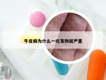 牛皮癣为什么一吃发物就严重