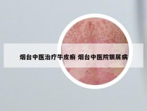 烟台中医治疗牛皮癣 烟台中医院银屑病