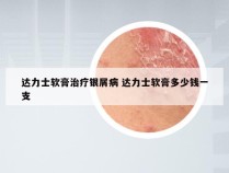 达力士软膏治疗银屑病 达力士软膏多少钱一支