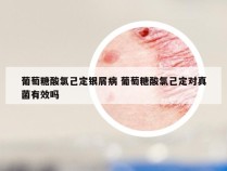 葡萄糖酸氯己定银屑病 葡萄糖酸氯己定对真菌有效吗