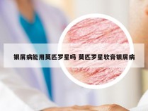 银屑病能用莫匹罗星吗 莫匹罗星软膏银屑病