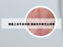 膝盖上会不会长癣 膝盖处长癣怎么回事