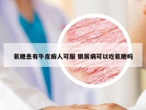 氨糖患有牛皮癣人可服 银屑病可以吃氨糖吗