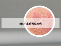 维C牛皮癣可以吃吗