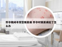怀孕期间寻常型银屑病 怀孕时银屑病犯了怎么办