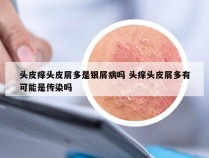 头皮痒头皮屑多是银屑病吗 头痒头皮屑多有可能是传染吗