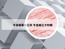 牛皮癣第一三共 牛皮癣三个时期