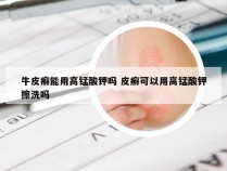 牛皮癣能用高锰酸钾吗 皮癣可以用高锰酸钾擦洗吗