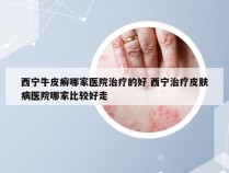 西宁牛皮癣哪家医院治疗的好 西宁治疗皮肤病医院哪家比较好走