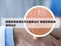 脓疱型银屑病关节炎最新治疗 脓疱型银屑病如何治疗