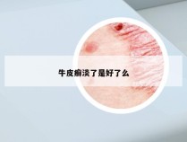 牛皮癣淡了是好了么