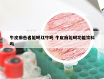 牛皮癣患者能喝红牛吗 牛皮癣能喝功能饮料吗