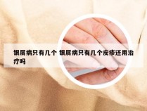 银屑病只有几个 银屑病只有几个皮疹还用治疗吗