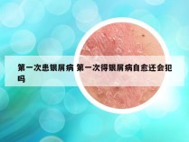 第一次患银屑病 第一次得银屑病自愈还会犯吗