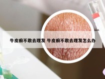牛皮癣不敢去理发 牛皮癣不敢去理发怎么办