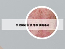 牛皮癣可手术 牛皮肤癣手术