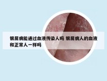 银屑病能通过血液传染人吗 银屑病人的血液和正常人一样吗