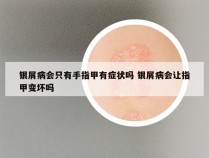银屑病会只有手指甲有症状吗 银屑病会让指甲变坏吗