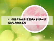 B27阳性有牛皮癣 银屑病关节炎b27阴性阳性有什么区别