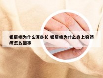 银屑病为什么浑身长 银屑病为什么身上突然痒怎么回事
