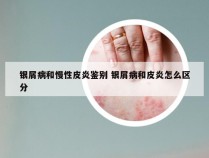 银屑病和慢性皮炎鉴别 银屑病和皮炎怎么区分