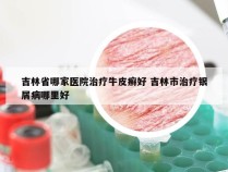 吉林省哪家医院治疗牛皮癣好 吉林市治疗银屑病哪里好