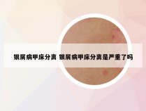 银屑病甲床分离 银屑病甲床分离是严重了吗