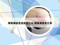 银屑病自愈征兆是什么 银屑病自愈几率