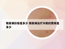 银屑病价格是多少 银屑病治疗大概的费用是多少