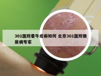 301医院看牛皮癣如何 北京301医院银屑病专家