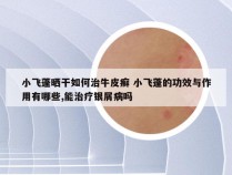小飞蓬晒干如何治牛皮癣 小飞蓬的功效与作用有哪些,能治疗银屑病吗