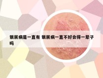 银屑病是一直有 银屑病一直不好会得一辈子吗