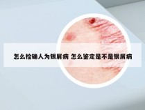 怎么检确人为银屑病 怎么鉴定是不是银屑病