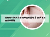 西安哪个银屑病看的好医院是哪家 西安银屑病哪家最好