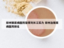 郑州银屑病医院皆择刘长江实力 郑州治银屑病医院排名