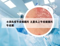 小孩头皮牛皮癣图片 儿童头上牛皮廨图片 牛皮廨