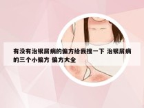 有没有治银屑病的偏方给我搜一下 治银屑病的三个小偏方 偏方大全